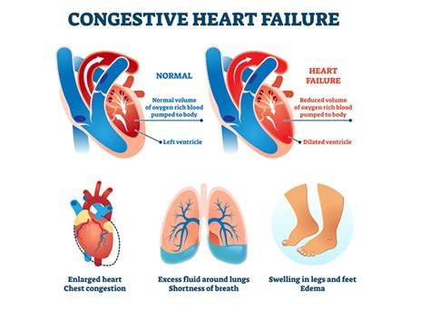 What Triggers Congestive Heart Failure