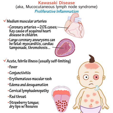 What Triggers Kawasaki Disease