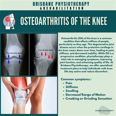What Triggers Knee Osteoarthritis Pain