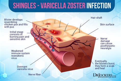 What Triggers Shingles In The Eye