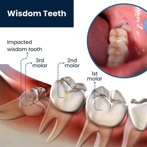 What Triggers Wisdom Teeth To Grow