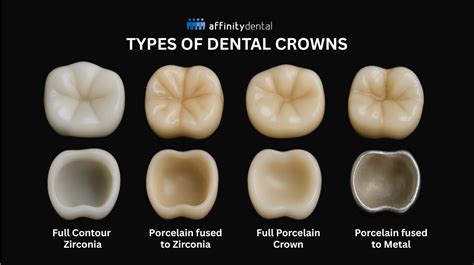 What's A Crown In Dentistry