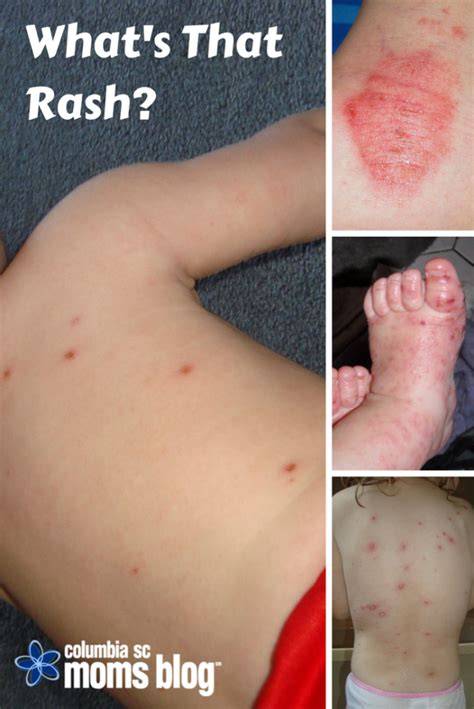 Whats Skin Rash
