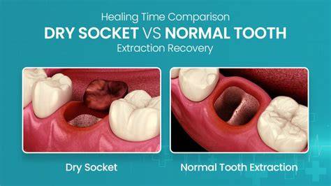 When Does Dry Socket Happen