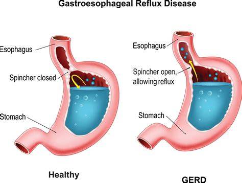 When Does Gerd Happen