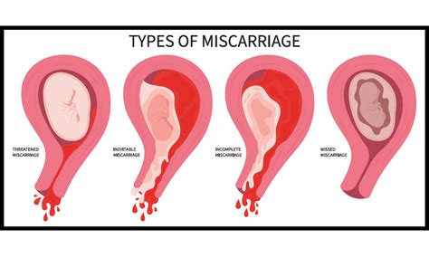 When Does Miscarriage Happen