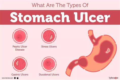 When Does Ulcer Happen