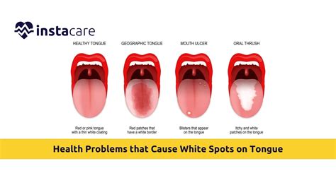 White Tongue With White Spots