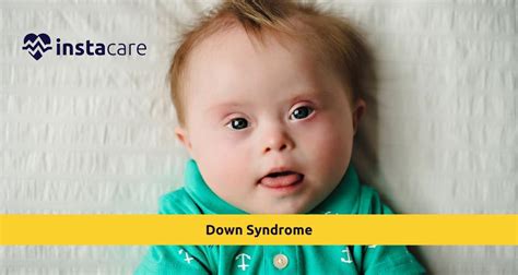 Who Named Down Syndrome