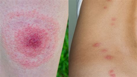 Why Do Bug Bites Itch