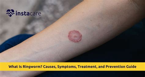 Why Is Called Ringworm