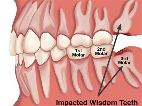 Why Is Called Wisdom Teeth