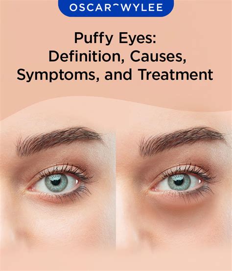 Why My Eyelids Are Puffy
