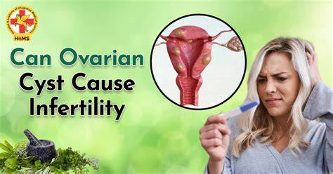 Will Ovarian Cysts Cause Infertility