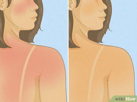 Will Sunburn Turn To Tan