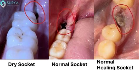 Wisdom Socket Healing