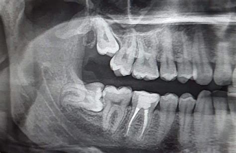 Wisdom Teeth Xray