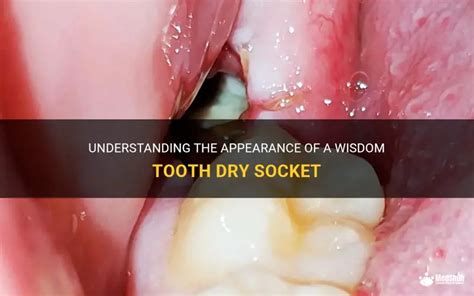 Wisdom Tooth Dry Socket