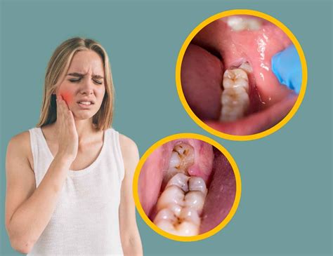 Wisdom Tooth Pain Symptoms