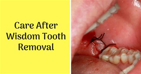 Wisdom Tooth Removal Care After