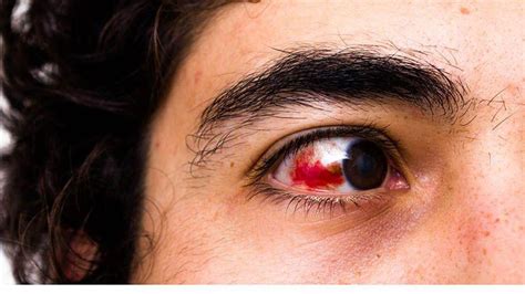 Woke Up Bloodshot Eye