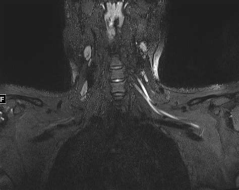 Would Mri Show Nerve Damage