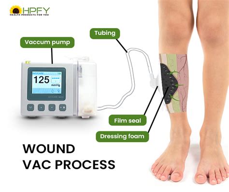 Wound Vacs For Wound Therapy