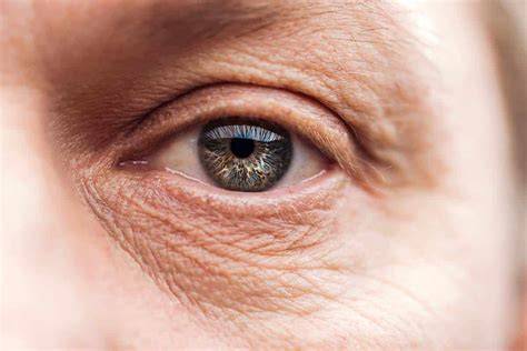 Wrinkles Around Eyes