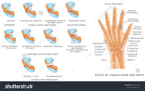 Wrist Fracture Types