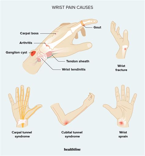 Wrist Tenderness Causes