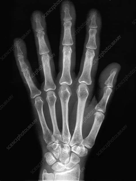 X Ray Normal Hand