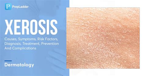 Xerosis Of Skin