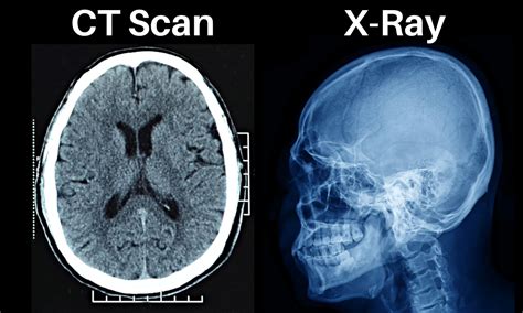 Xray Vs Ct Scan