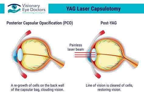 Yag Laser Eye Surgery
