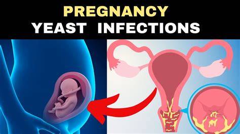 Yeast Infection During Pregnancy