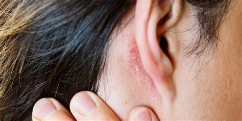 Yeast Infection In Ear