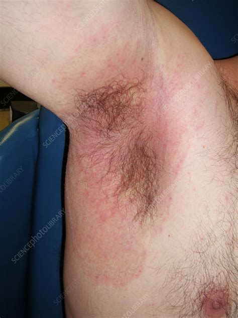 Yeast Infection Under Armpit