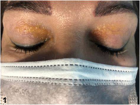 Yellow Around Eyelids