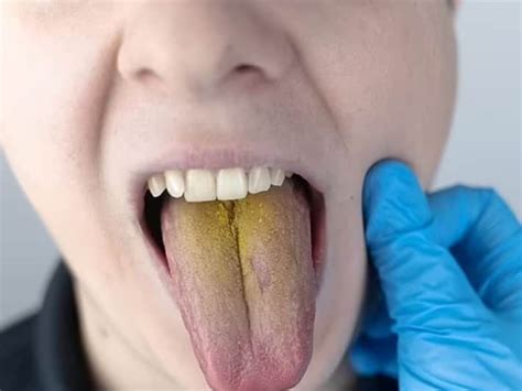 Yellow Colour Tongue