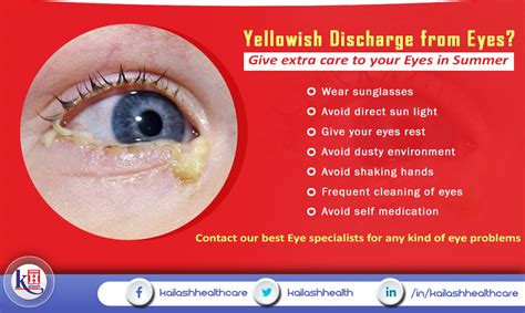 Yellow Discharge Out Of Eye