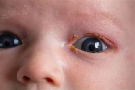 Yellow Eye Boogers Newborn