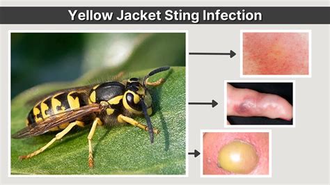 Yellow Jacket Stings