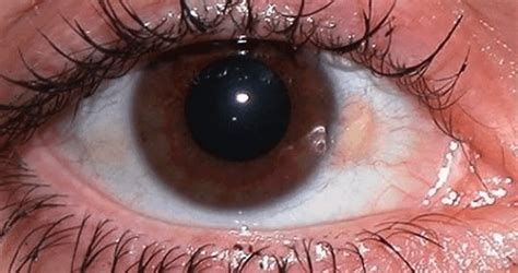 Yellow Patch In Eye