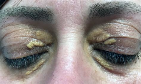 Yellow Spots In Eyelids