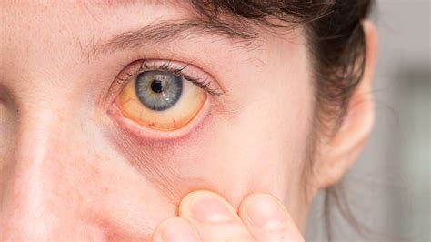 Yellow Whites In Eyes