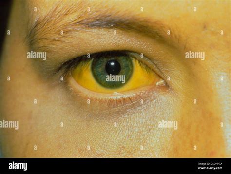 Yellowing In White Of Eyes