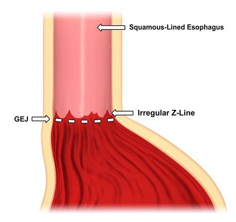 Z Line Esophagus