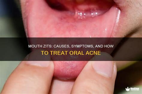 Zit In Mouth