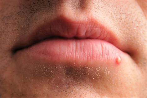 Zit On Lip